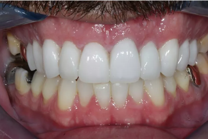 porcelain dental crowns after