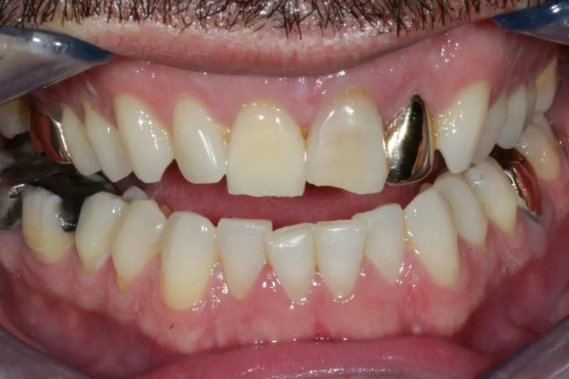porcelain dental crowns before