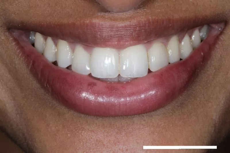 After invisalign and composite bonding