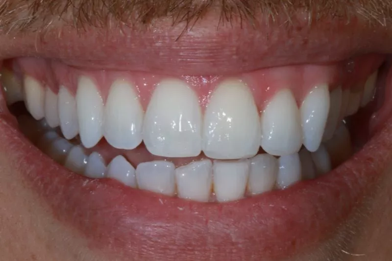 Invisalign whitening and bonding