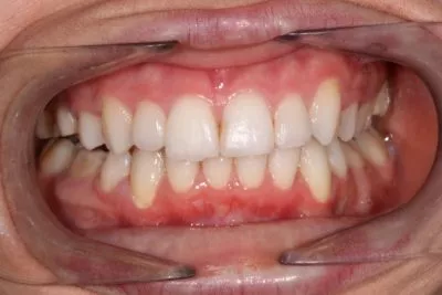 braces-before-after-simona-result braces before after result simona