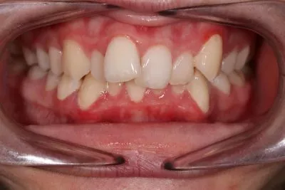 braces-before-after-simona braces before after simona